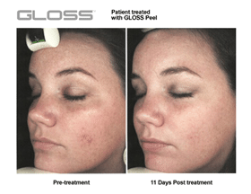 Gloss Peel