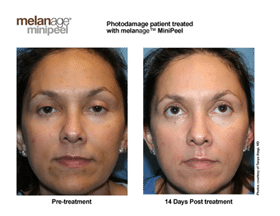 Gloss Peel