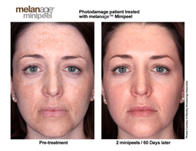 Melange Mini Peel