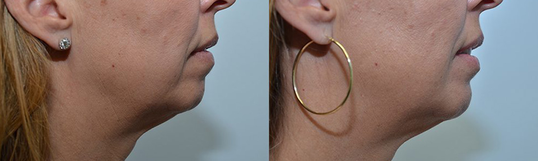 Radiesse Before & After