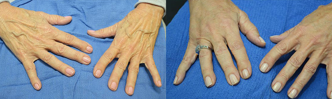 Radiesse Before & After