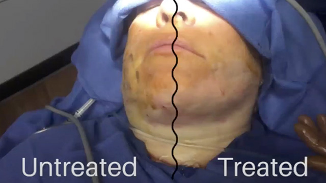 FaceTite Treatment