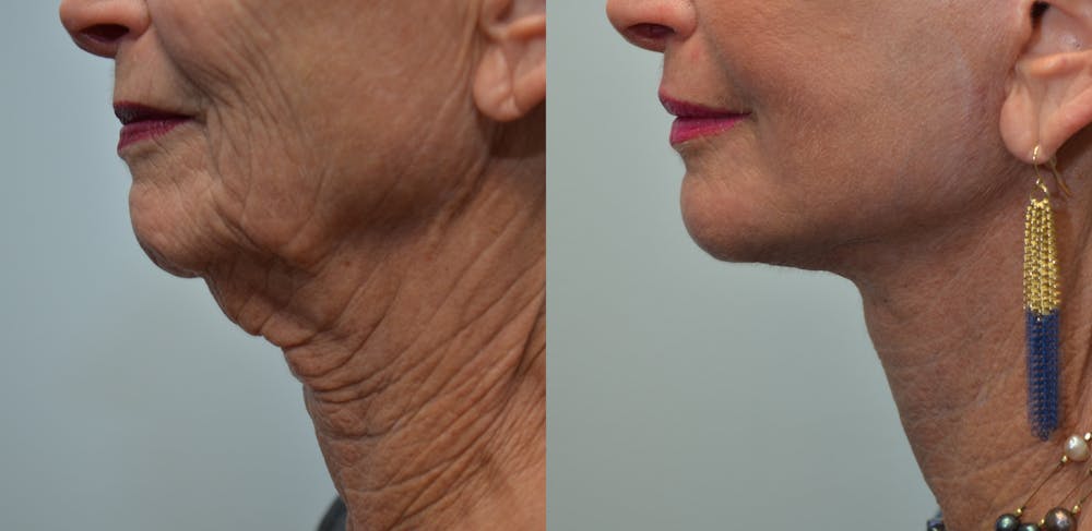 Facelift Before & After Gallery - Patient 4588106 - Image 1