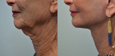 Deep Plane Facelift Before & After Gallery - Patient 4588106 - Image 1