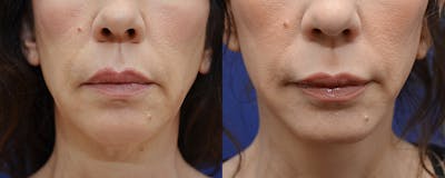 Deep Plane Facelift Before & After Gallery - Patient 4588114 - Image 1