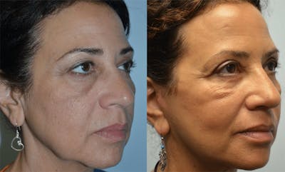 Facelift Before & After Gallery - Patient 4588115 - Image 1