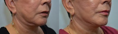 Deep Plane Facelift Before & After Gallery - Patient 4588118 - Image 2