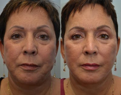 Facelift Before & After Gallery - Patient 4588118 - Image 1