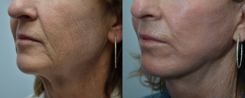 Facelift Before & After Gallery - Patient 4588126 - Image 1