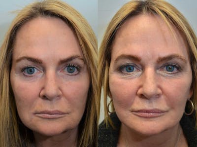 Deep Plane Facelift Before & After Gallery - Patient 4588151 - Image 2