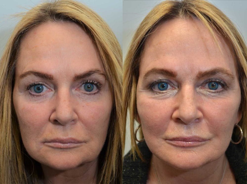 Facelift Before & After Gallery - Patient 4588151 - Image 2