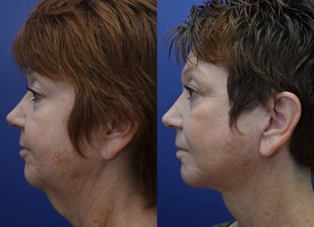 Facelift Before & After Gallery - Patient 4588152 - Image 1
