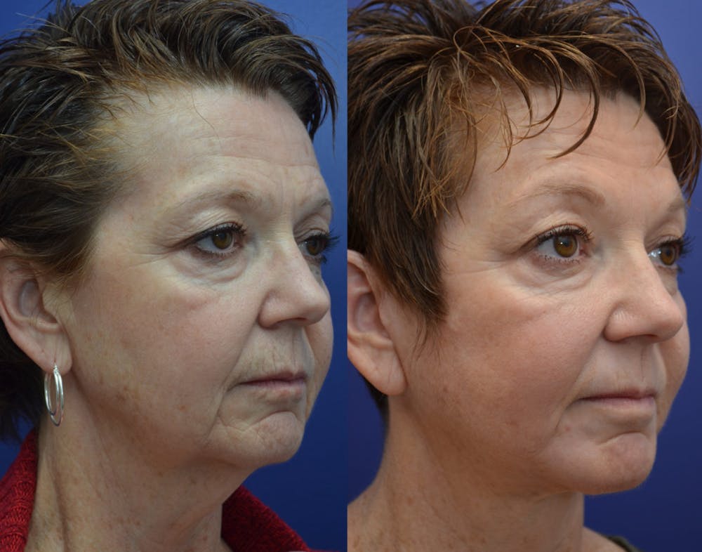 Deep Plane Facelift Before & After Gallery - Patient 4588152 - Image 2