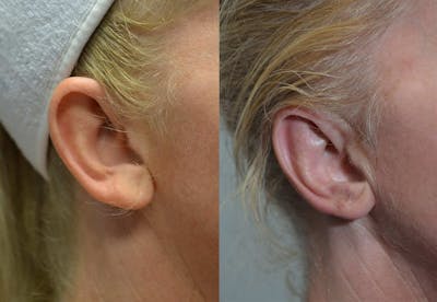 Ear Reshaping (Otoplasty) Before & After Gallery - Patient 4588250 - Image 4