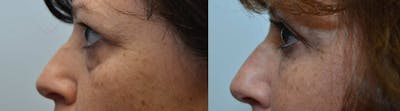 Facial Revolumizing (Fat Transfer) Before & After Gallery - Patient 4588316 - Image 2