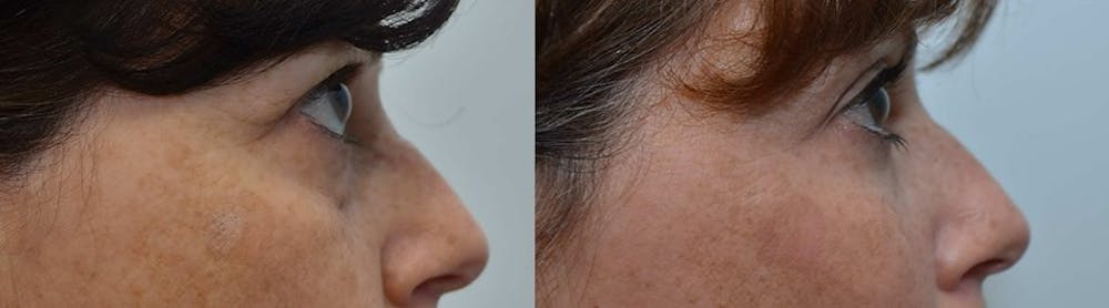Facial Revolumizing (Fat Transfer) Before & After Gallery - Patient 4588316 - Image 3
