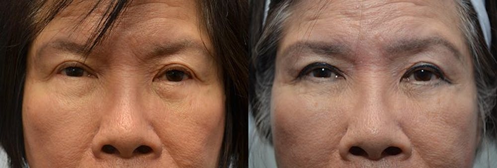 Facial Revolumizing (Fat Transfer) Before & After Gallery - Patient 4588317 - Image 1