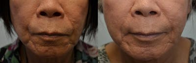 Facial Revolumizing (Fat Transfer) Before & After Gallery - Patient 4588317 - Image 2