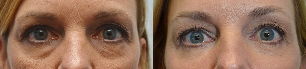 Facial Revolumizing (Fat Transfer) Before & After Gallery - Patient 4588318 - Image 2