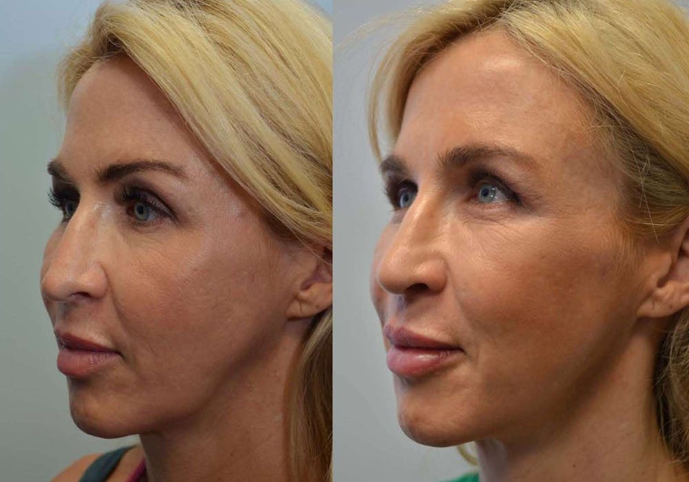 Facial Revolumizing (Fat Transfer) Before & After Gallery - Patient 4588318 - Image 3