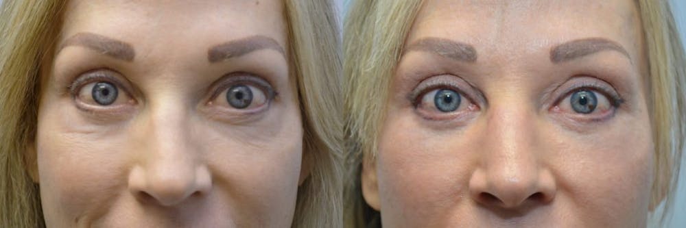 Facial Revolumizing (Fat Transfer) Before & After Gallery - Patient 4588320 - Image 1