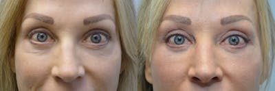 Facial Revolumizing (Fat Transfer) Before & After Gallery - Patient 4588320 - Image 1
