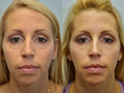 Facial Revolumizing (Fat Transfer) Before & After Gallery - Patient 4588321 - Image 1