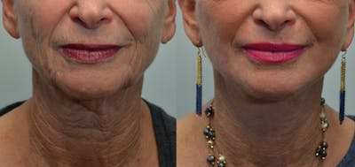 Deep Plane Neck Lift Before & After Gallery - Patient 4588338 - Image 2