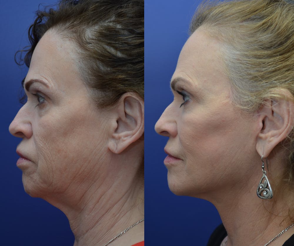 Deep Plane Neck Lift Before & After Gallery - Patient 4588339 - Image 1