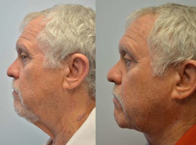 Neck Lift Before & After Gallery - Patient 4588340 - Image 2