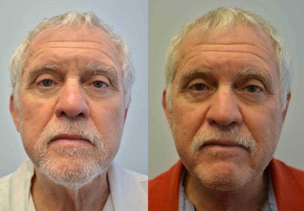 Neck Lift Before & After Gallery - Patient 4588340 - Image 3