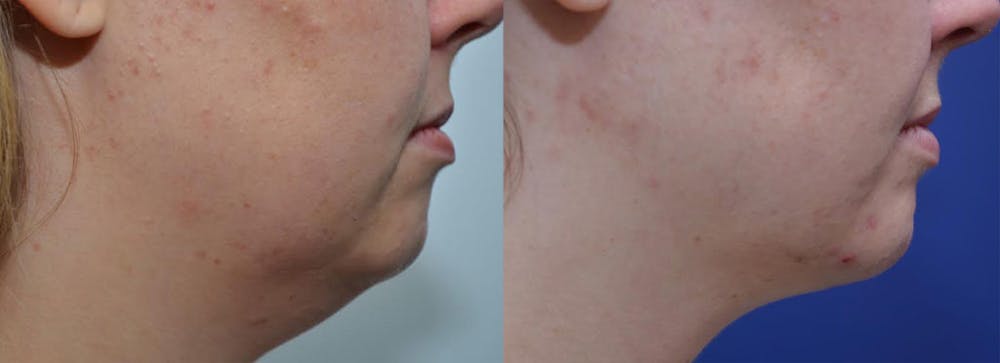 Neck Lift Before & After Gallery - Patient 4588342 - Image 1