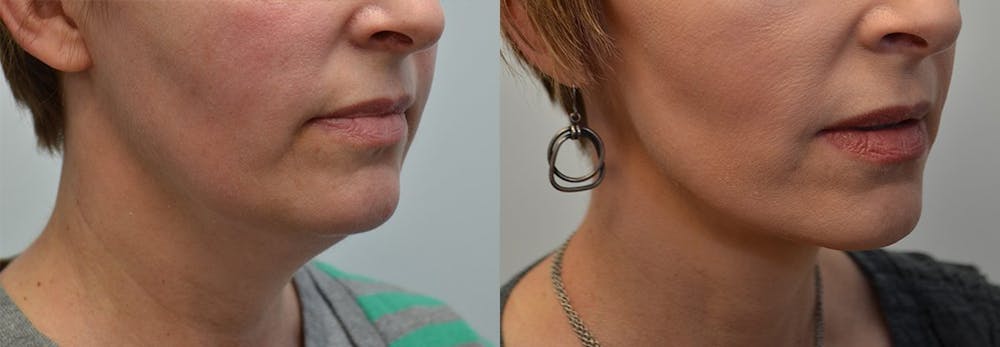 Neck Lift Before & After Gallery - Patient 4588344 - Image 1
