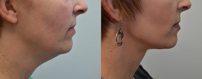 Deep Plane Neck Lift Before & After Gallery - Patient 4588344 - Image 2