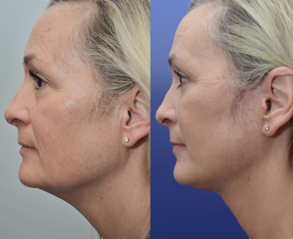 Deep Plane Neck Lift Before & After Gallery - Patient 4588345 - Image 1