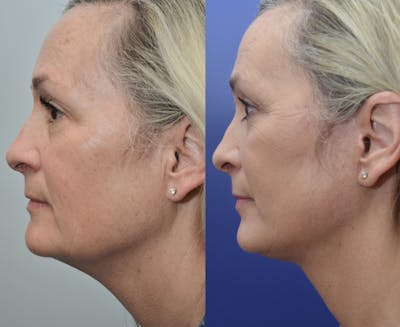 Neck Lift Before & After Gallery - Patient 4588345 - Image 1