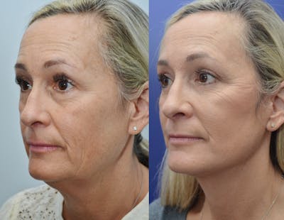 Deep Plane Neck Lift Before & After Gallery - Patient 4588345 - Image 4