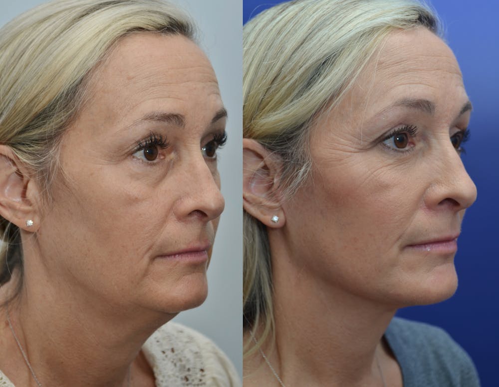 Deep Plane Neck Lift Before & After Gallery - Patient 4588345 - Image 3