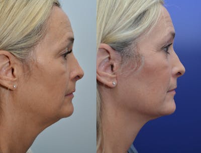 Deep Plane Neck Lift Before & After Gallery - Patient 4588345 - Image 2