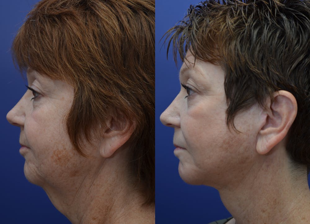 Deep Plane Neck Lift Before & After Gallery - Patient 4588347 - Image 1