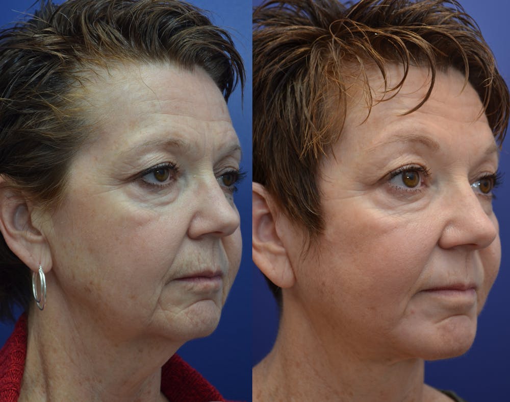 Deep Plane Neck Lift Before & After Gallery - Patient 4588347 - Image 2