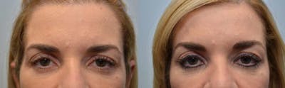 Botox / Xeomin / Dysport Before & After Gallery - Patient 4588377 - Image 1