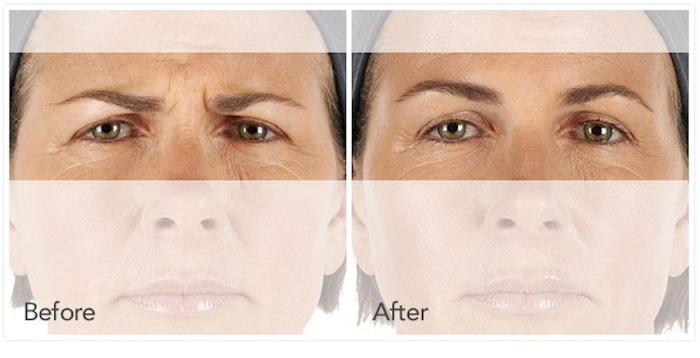 Botox / Xeomin / Dysport Before & After Gallery - Patient 4588378 - Image 1