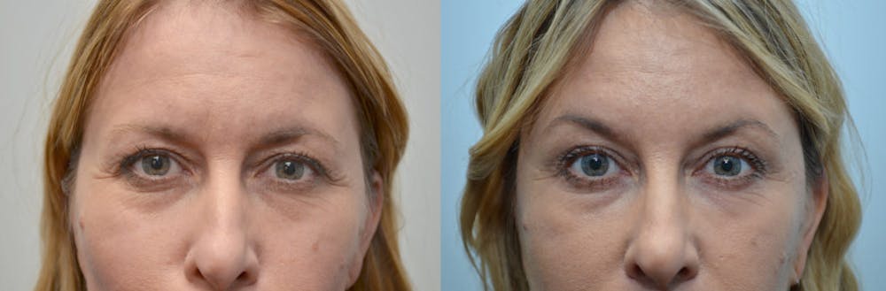 Botox / Xeomin / Dysport Before & After Gallery - Patient 4588381 - Image 1