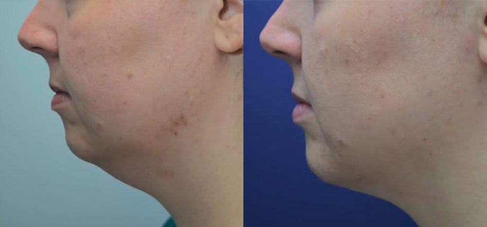 Liposuction Before & After Gallery - Patient 4588392 - Image 1
