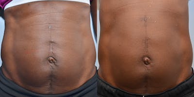 Cellulite Reduction Before & After Gallery - Patient 4588404 - Image 1
