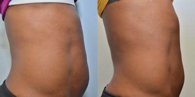 Cellulite Reduction Before & After Gallery - Patient 4588404 - Image 2