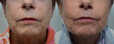 Dermabrasion / Chemical Peel Before & After Gallery - Patient 4588407 - Image 1