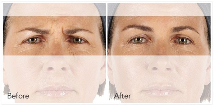 BOTOX