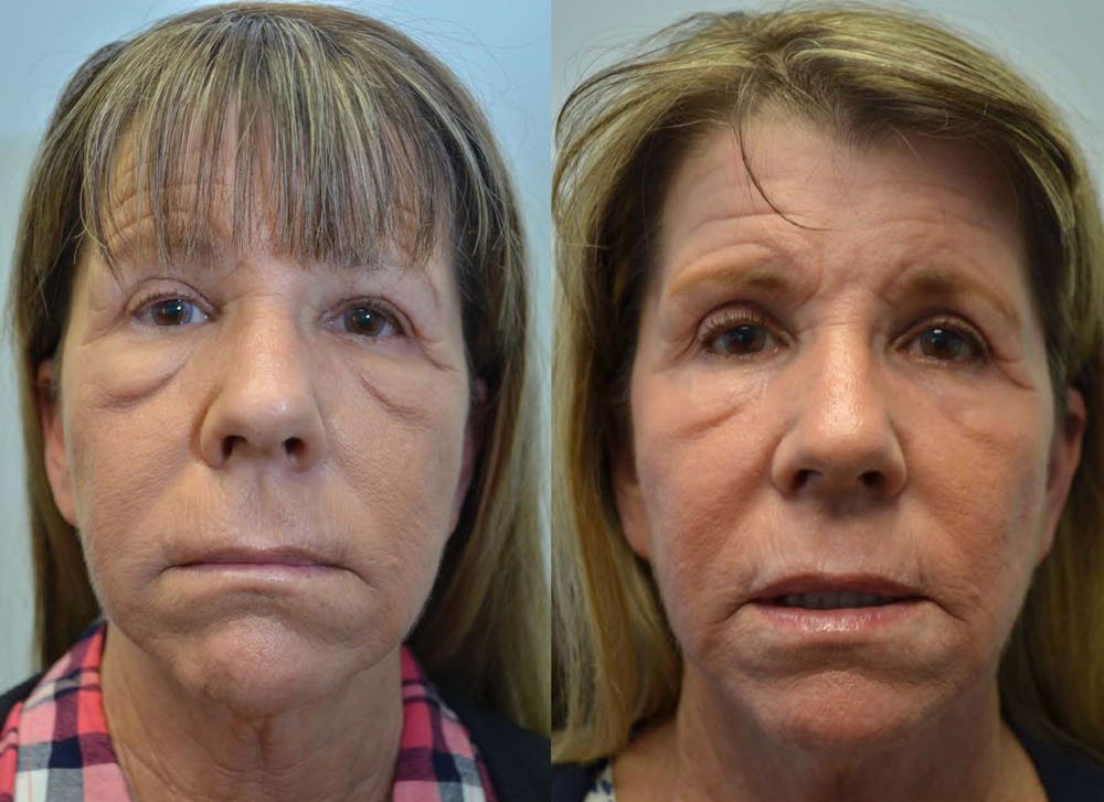 CO2 Laser Resurfacing Before & After Gallery - Patient 4588426 - Image 1